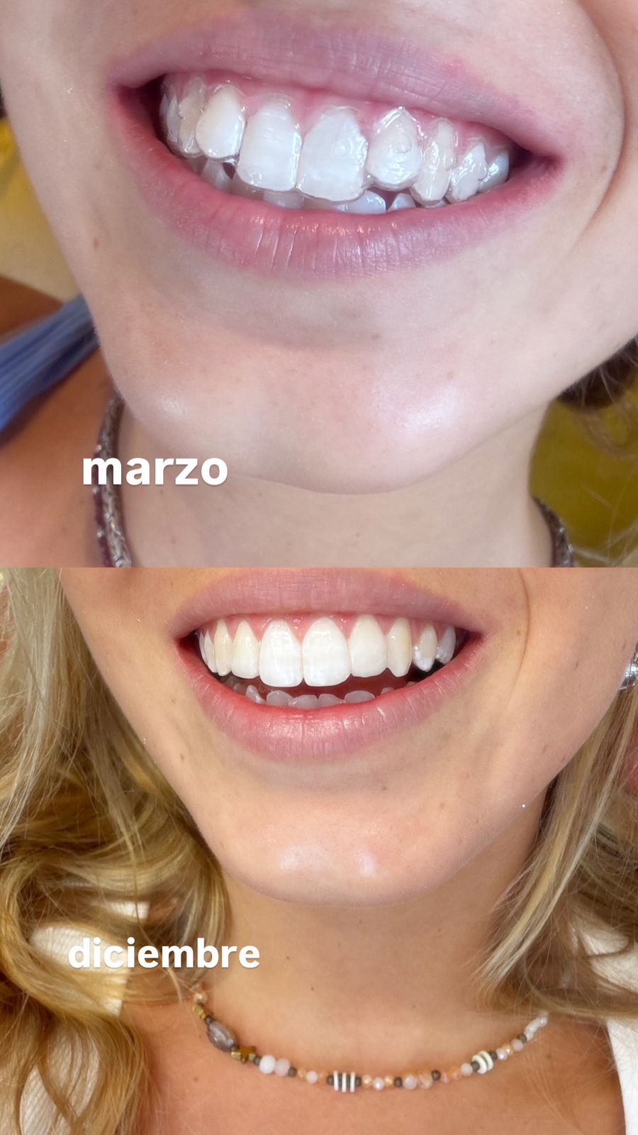 Antes y después ortodoncia invisible – Trafalgar